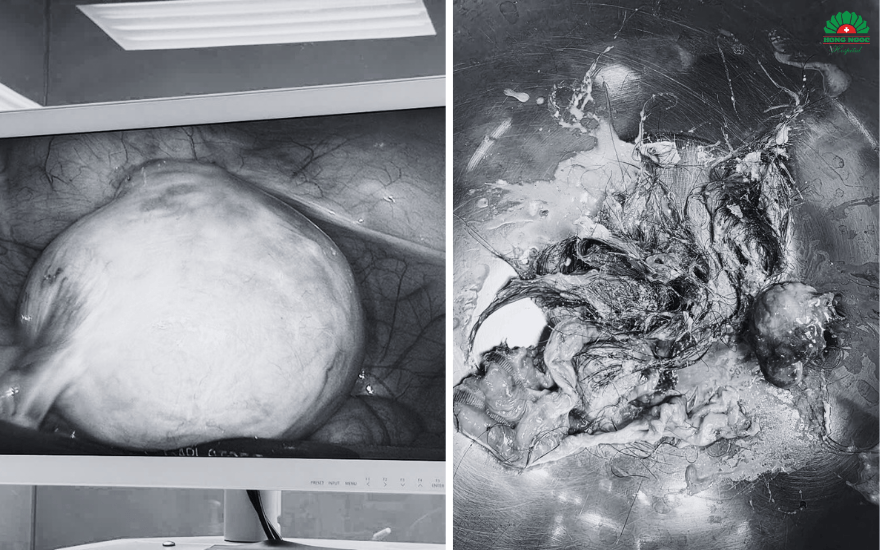 phẫu thuật u quái buồng trứng