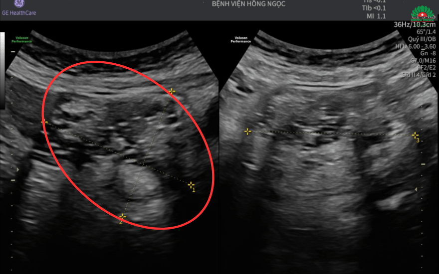 phẫu thuật u quái buồng trứng