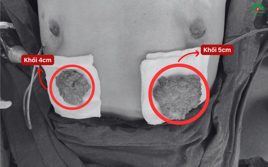 phẫu thuật phì đại tuyến vú