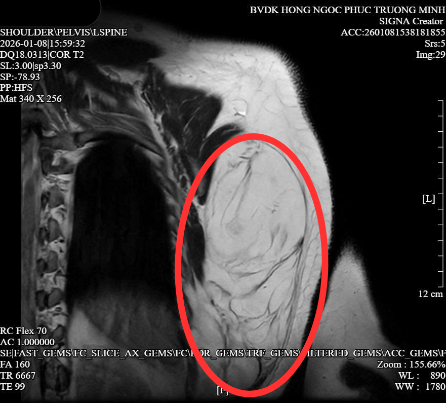 Hình ảnh MRI cho thấy khối u mỡ kích thước lớn vùng ngực – lưng trái người bệnh