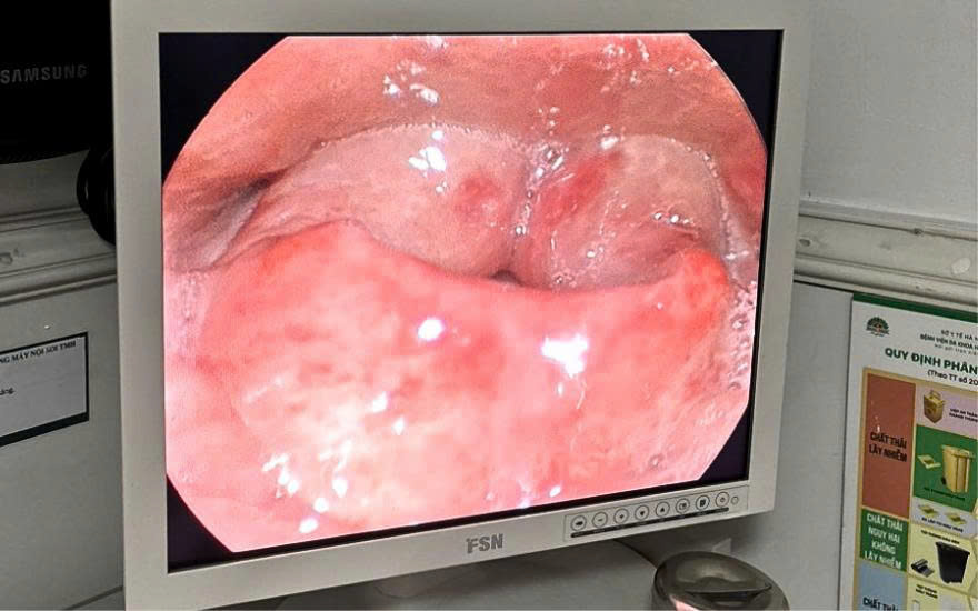 내시경 검사 결과는 충격적이었습니다. 