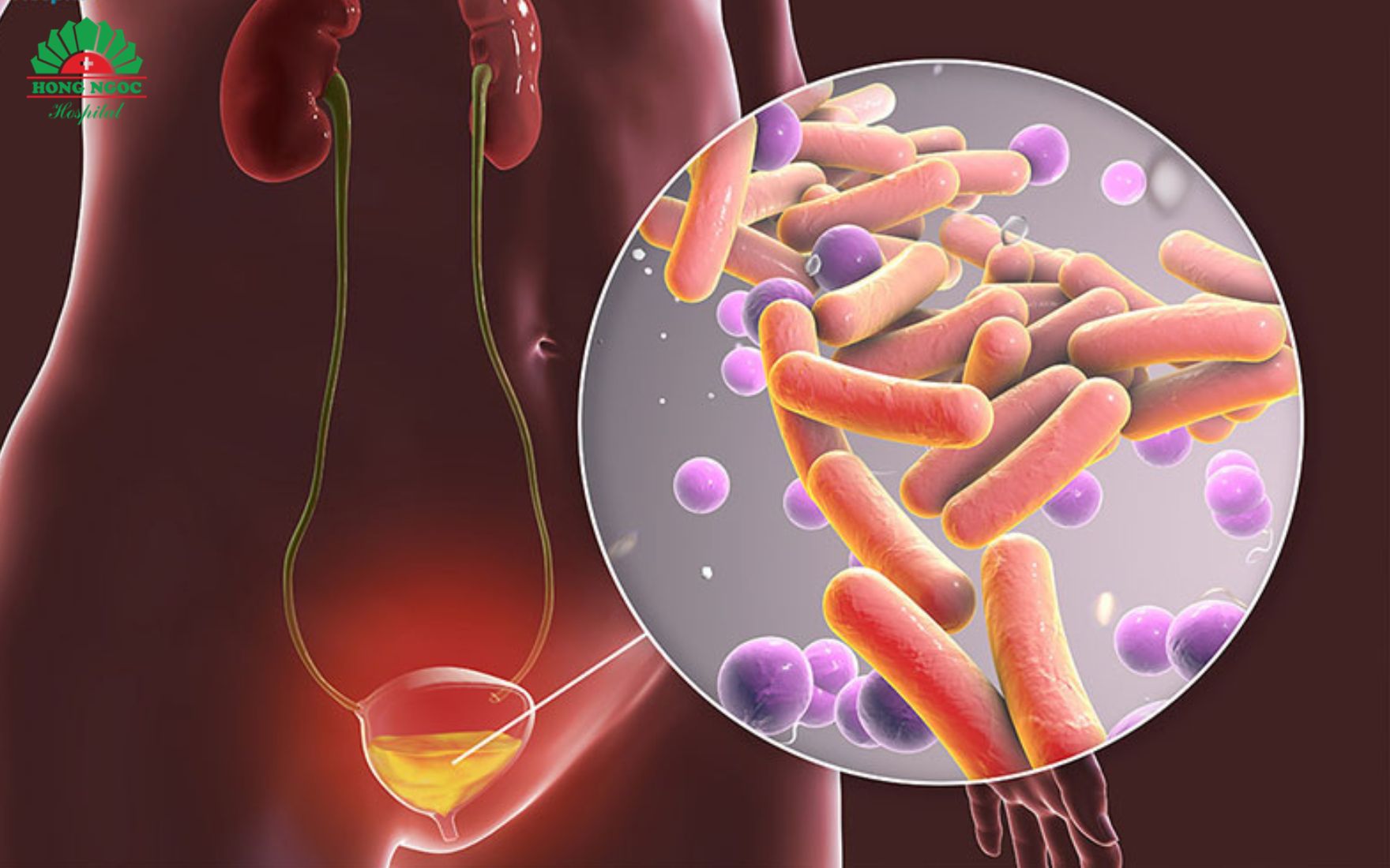 요로결석으로 인해 발생하는 합병증 중 하나가 요로 감염입니다.
