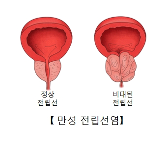 염증이 발생한 전립선이 정상보다 부어 커진 모습