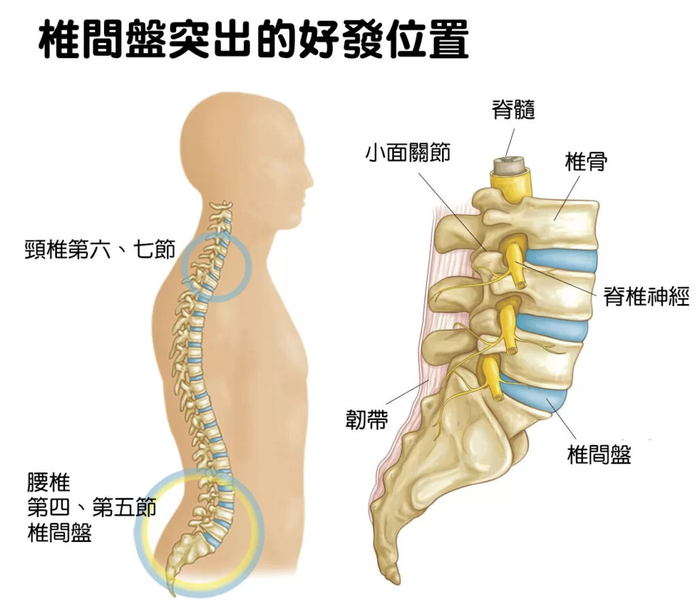 什么是椎间盘突出?