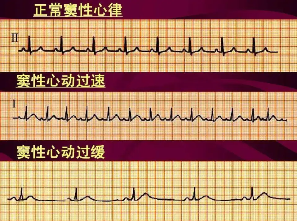 窦性心率每分钟超过100次即定义为该速。