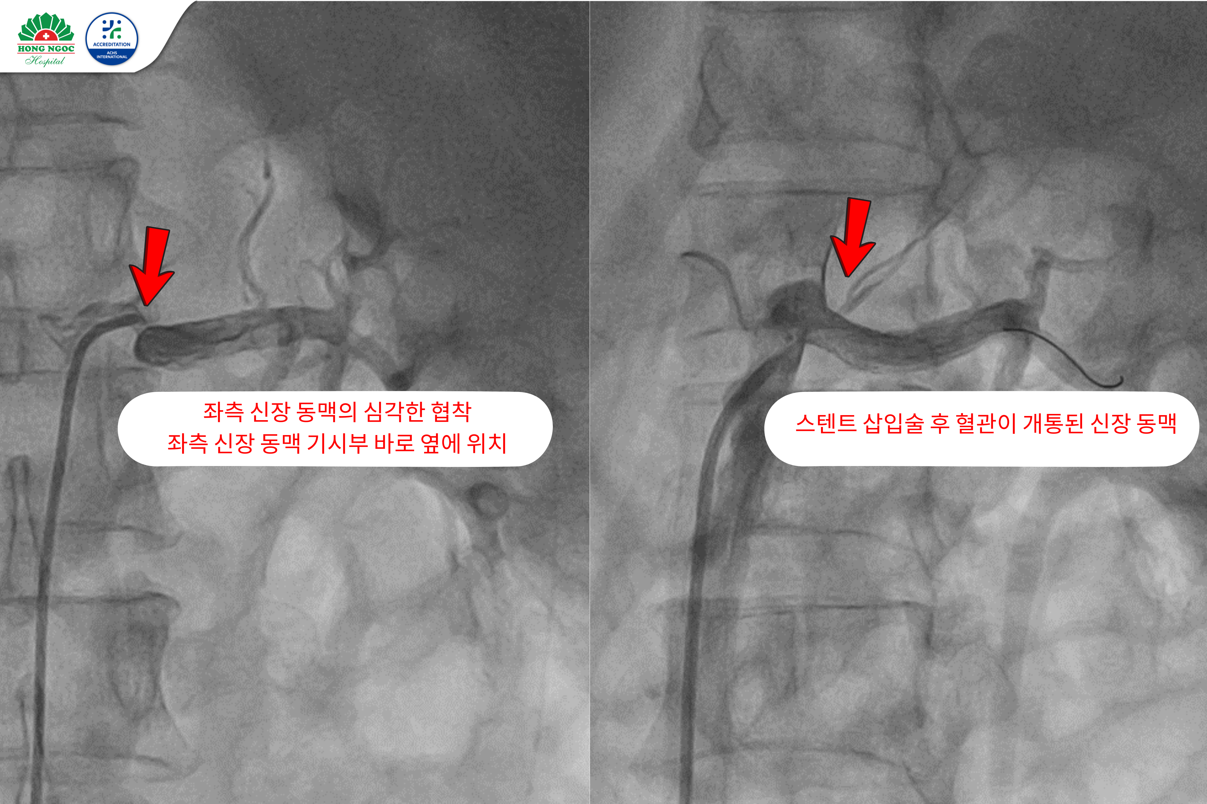 왼쪽 신장동맥 스텐트 삽입술 전후 이미지