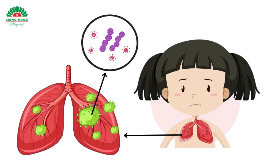 미성숙한 면역 체계는 아이들을 폐렴을 유발하는 바이러스와 세균에 취약하게 만듭니다.