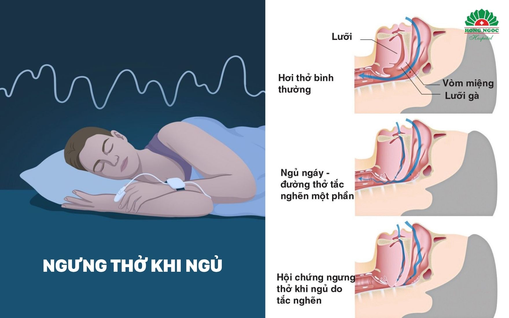 코골이는 수면무호흡증을 암시하는 가장 대표적인 초기 증상입니다.
