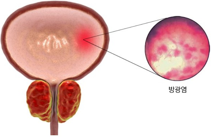 방광염은 방광 결석의 여러 합병증 중 하나입니다.