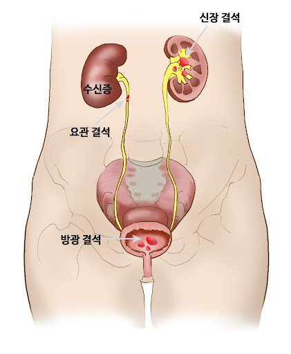 방광 결석은 다양한 경로를 통해 형성됩니다.