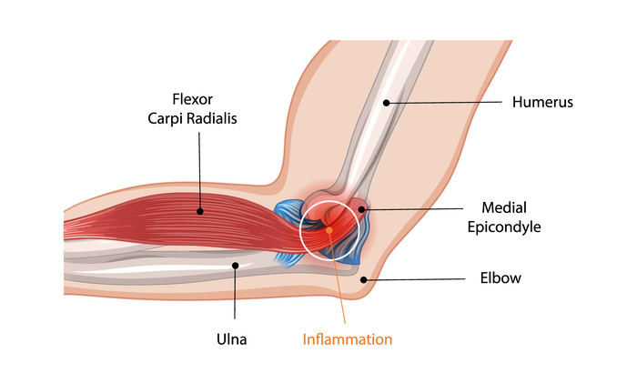 주관절 외상과염 위치