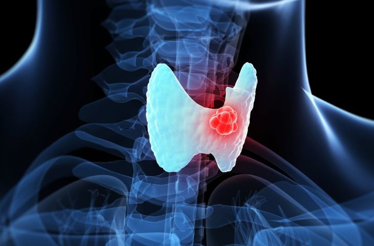갑상선암 치료 후 발생 가능한 합병증 
