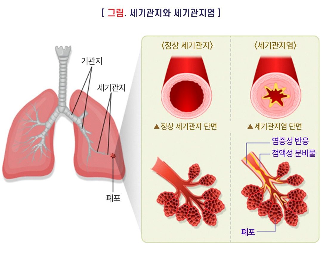 소아의 세기관지염은 세기관지에 염증이 생기고 붓고, 분비물이 과도하게 증가할 때 발생합니다.