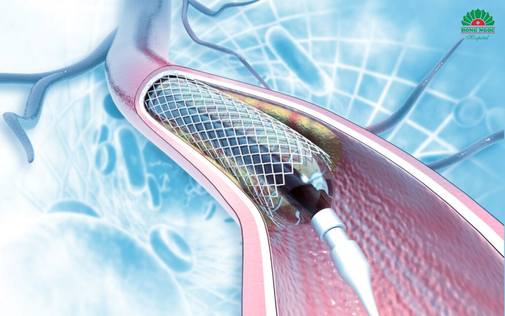 관상동맥 스텐트 삽입술