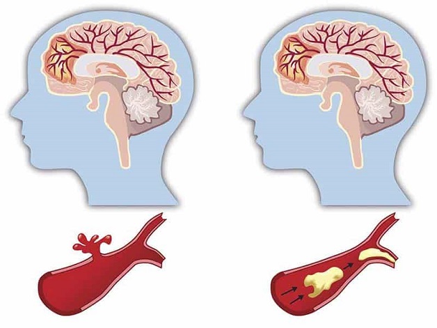 Cerebrovascular accidents are extremely dangerous cardiovascular diseases.