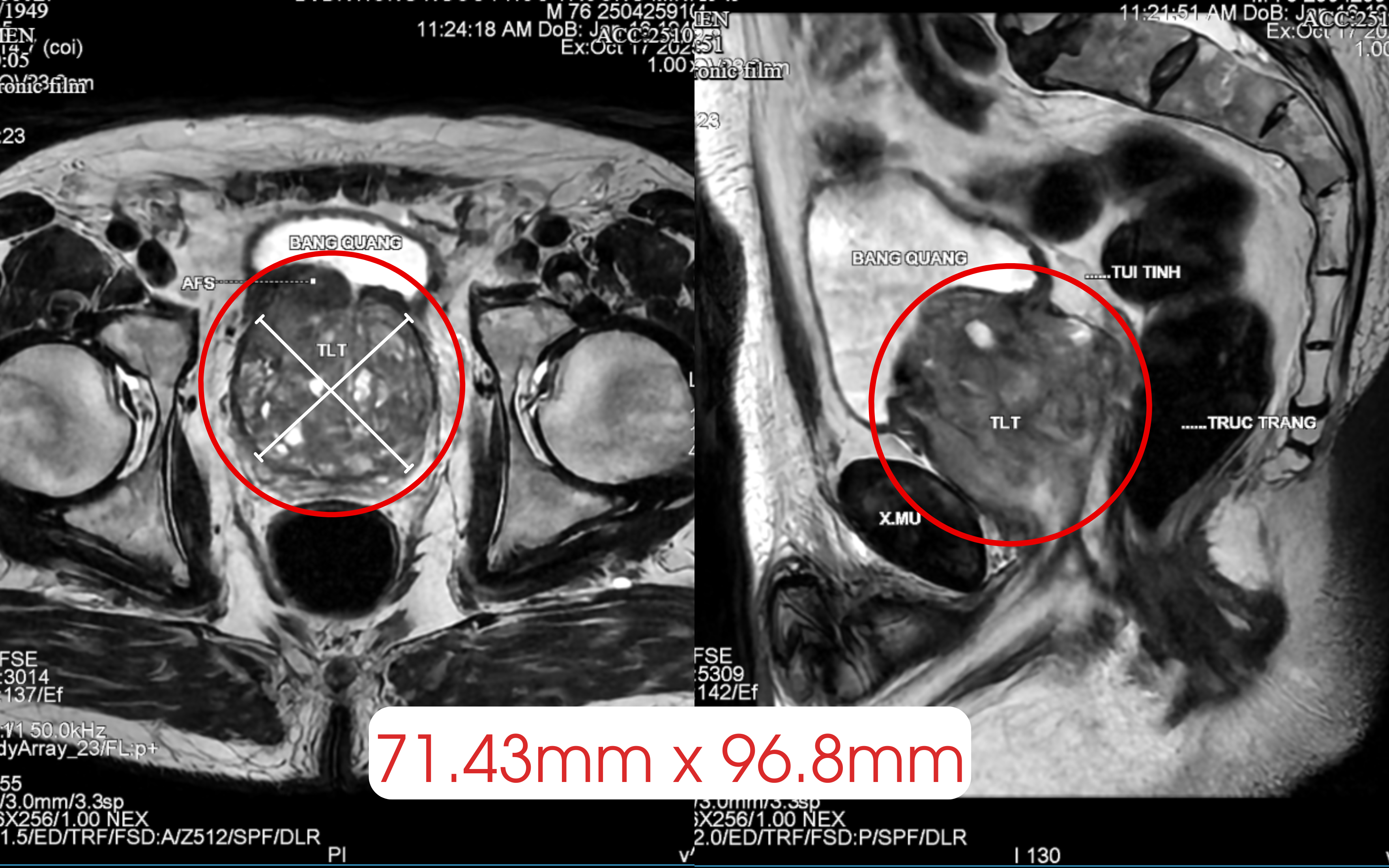 CT 영상에 나타난 거대 전립선 이미지