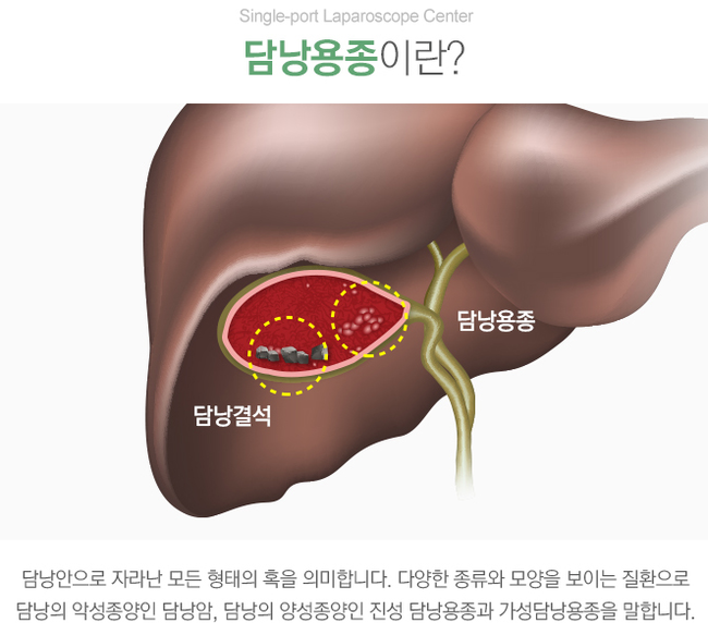담낭용종