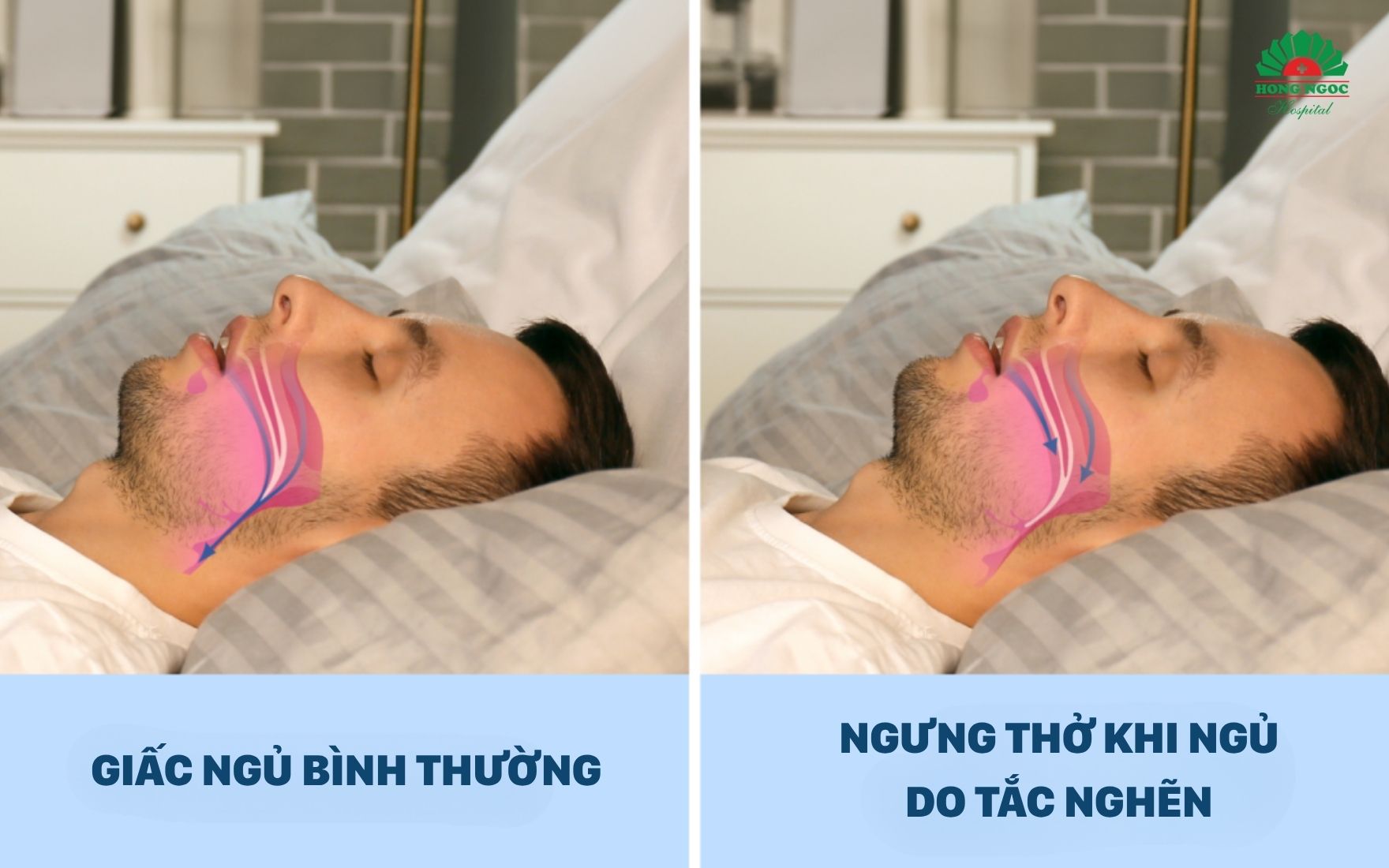 수면무호흡증은 수면 중 혈중 산소 포화도를 급격히 떨어뜨립니다.