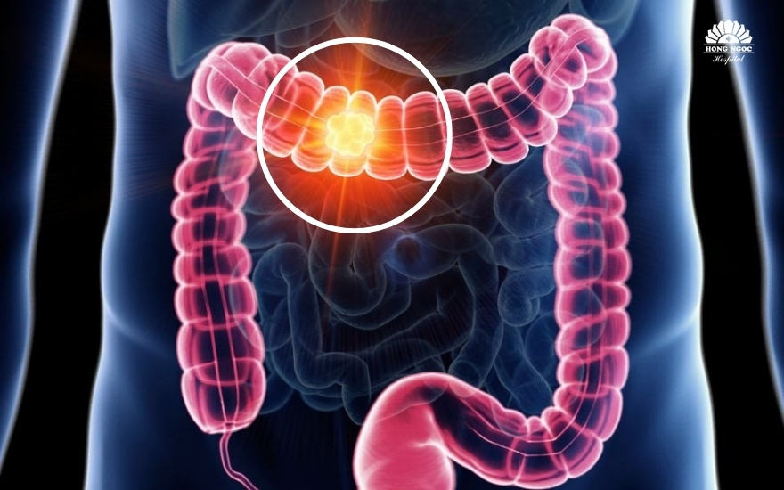 대장에 위치한 악성 종양(암 종양)