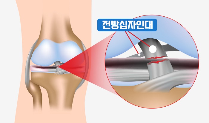 전방 십자인대 파열