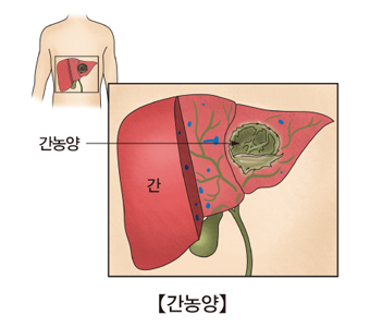 간 농양