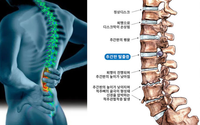 허리 디스크(추간판 탈출증)