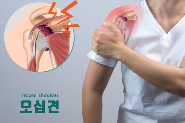유착성 관절낭염이라고도 불리는 오십견(동결견)