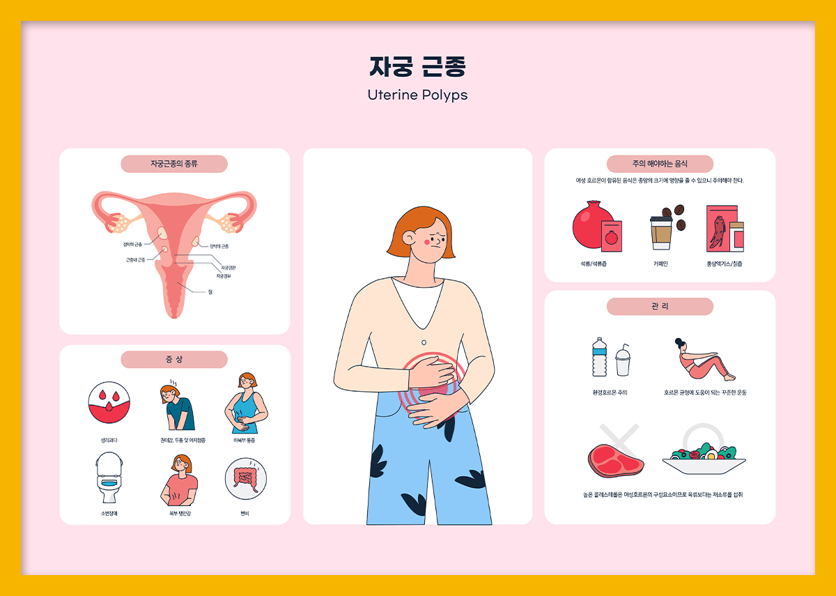 난소 낭종 또는 자궁내막암과 같은 난소 질환을 통해 자궁근종을 진단할 수 있습니다