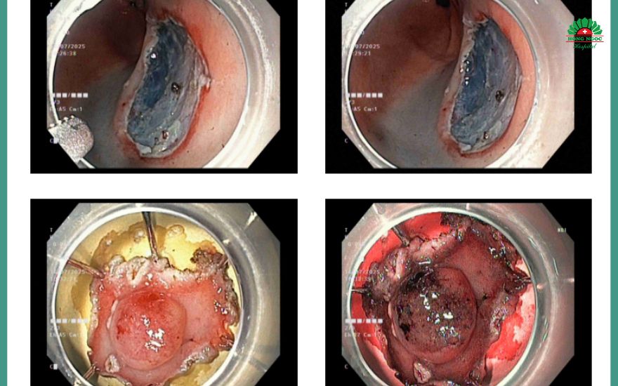 환자의 위 전정부에서 발견된 큰 용종