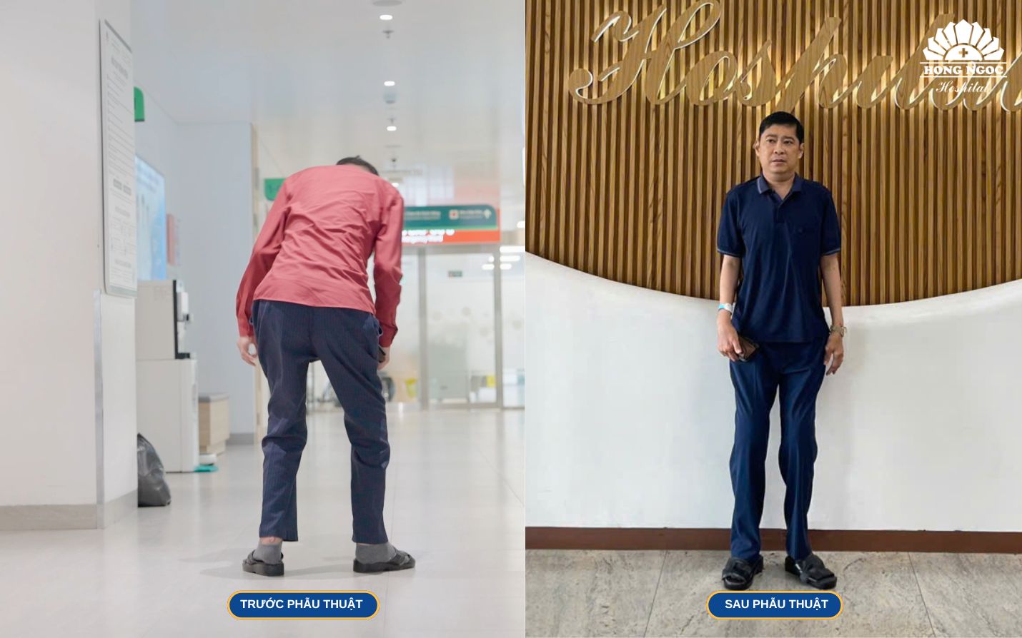 수술 후, 환자는 정상적인 운동 및 보행이 가능함