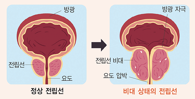 전립선 비대증은 중년 남성에게 흔히 발생하는 질환으로, 전립선이 정상보다 과도하게 커지는 상태를 말합니다.