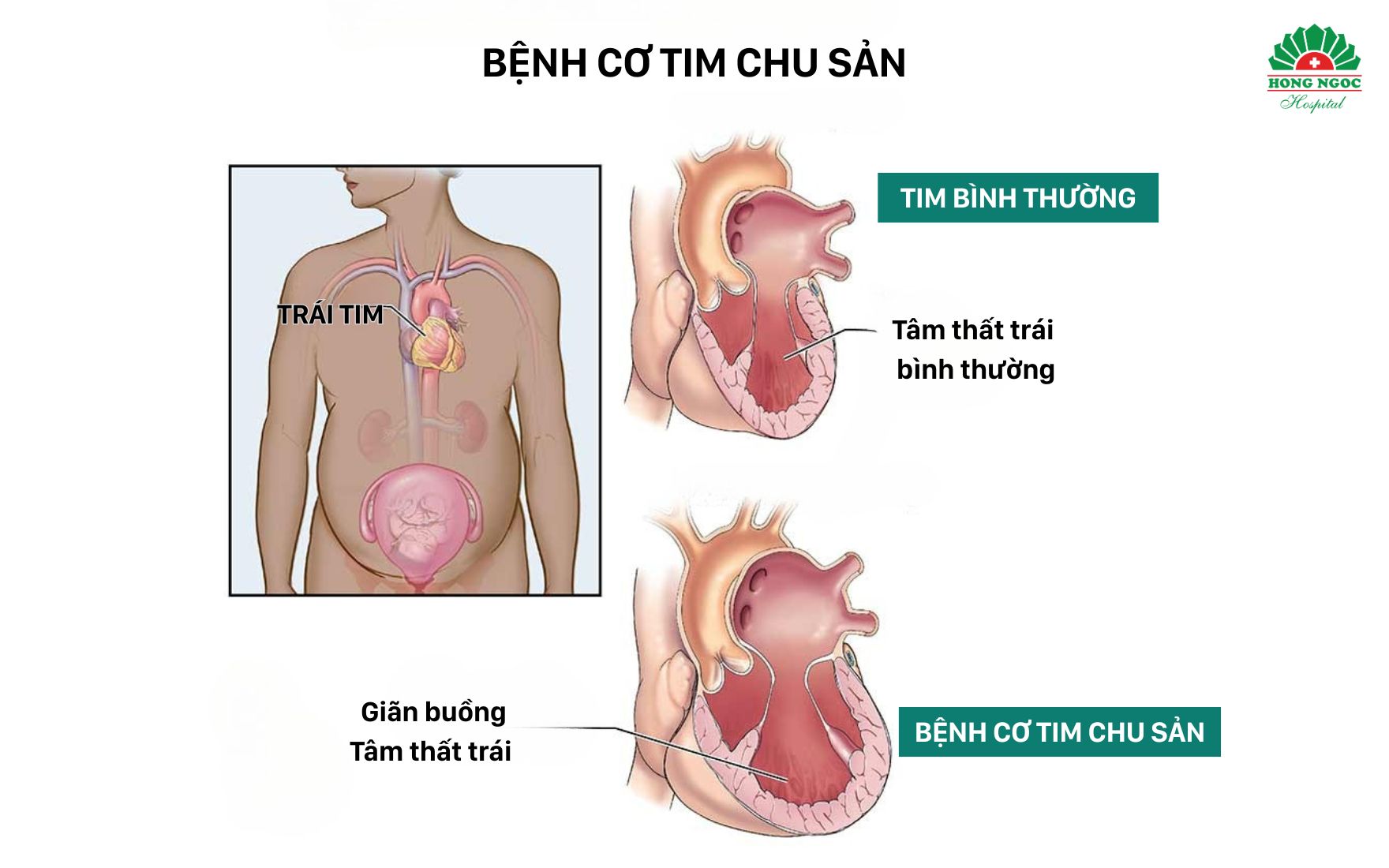 정상 임산부와 주산기 심근병증을 앓는 임산부의 심장 구조 비교 이미지