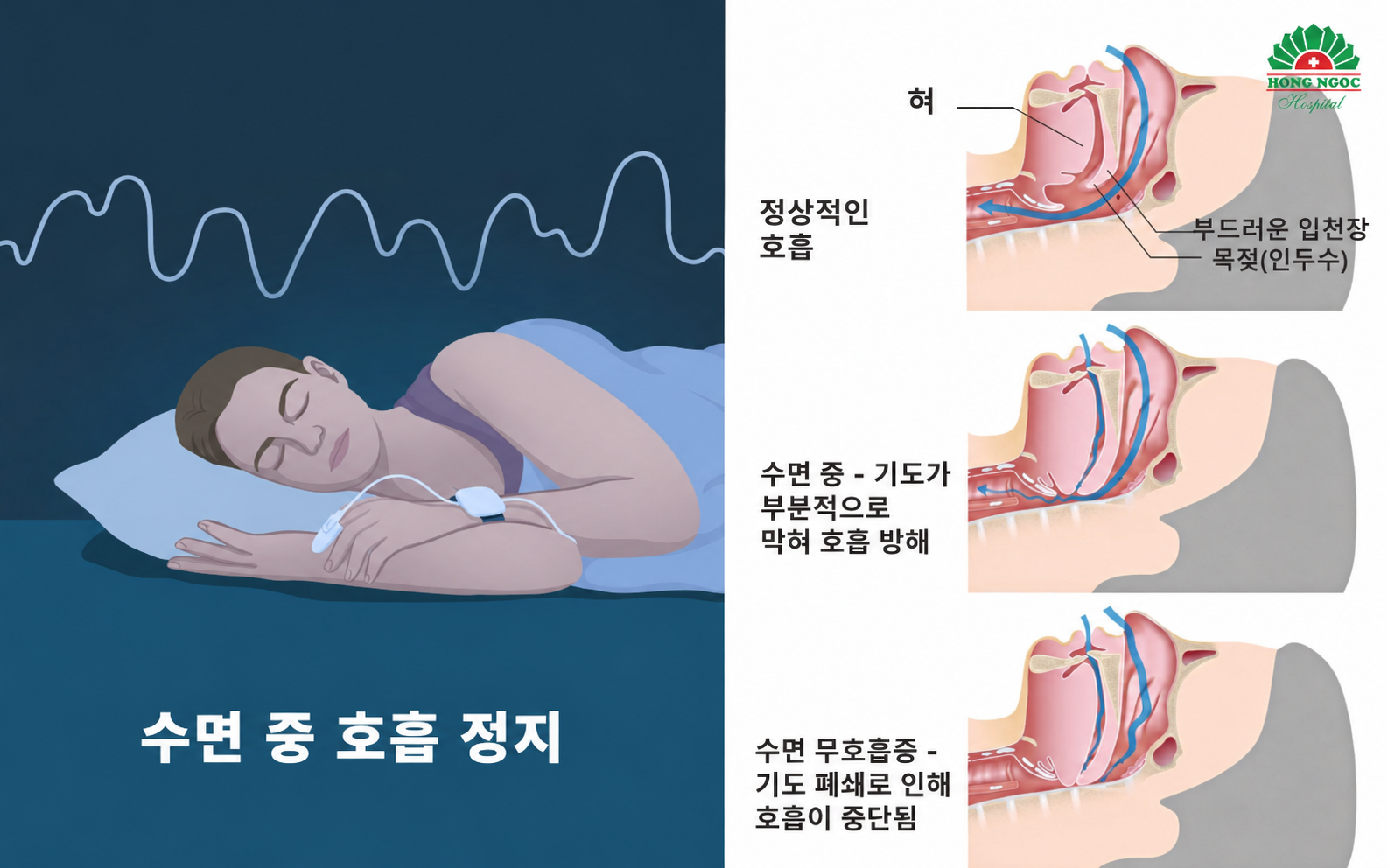 수면무호흡증