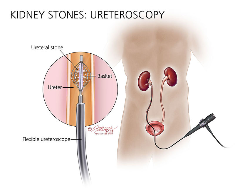 A stone that descends from the kidney and becomes lodged in the urethra is referred to as a urethral stone.
