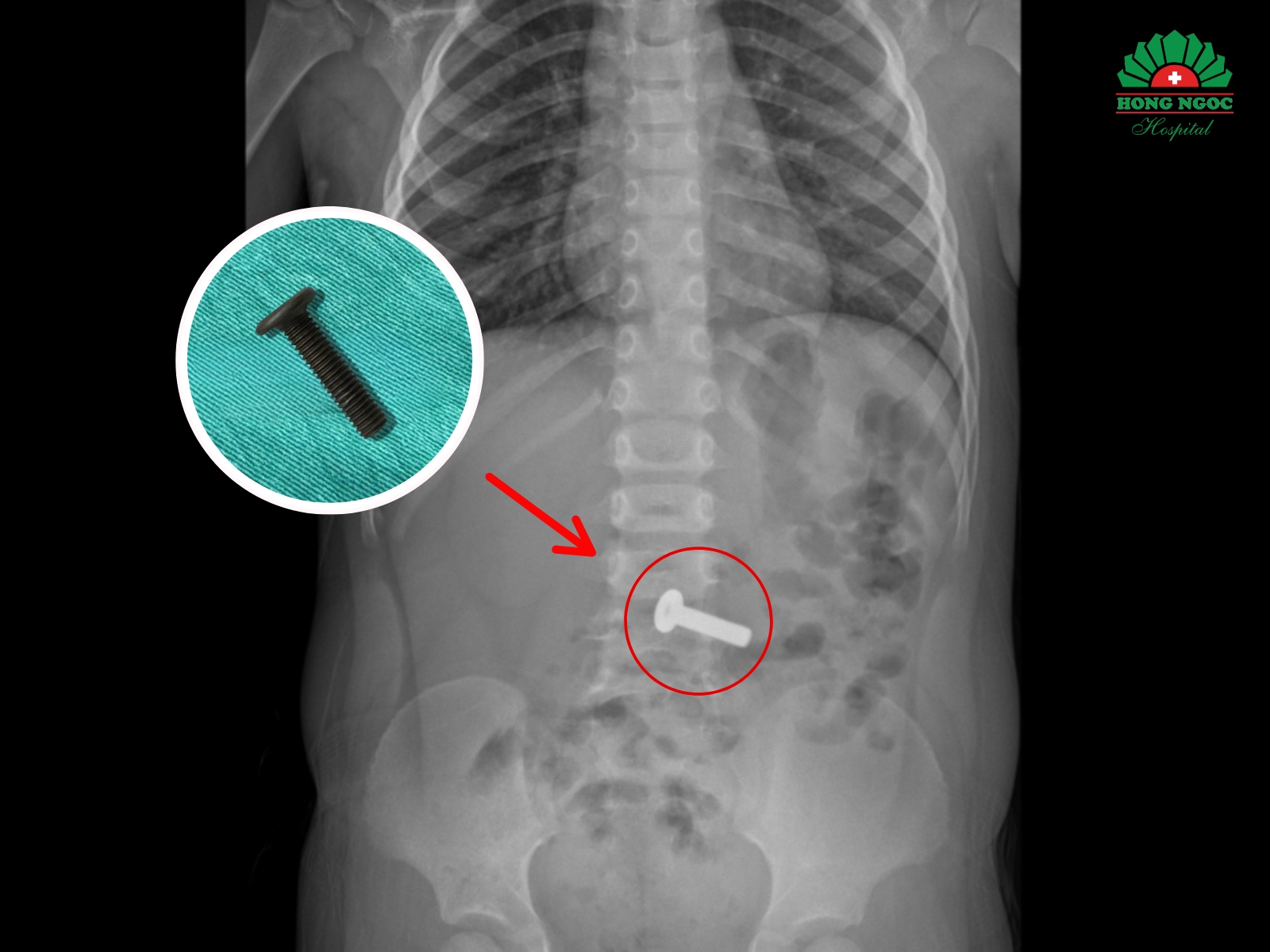 아동의 소화관 내에 있는 이물질 이미지