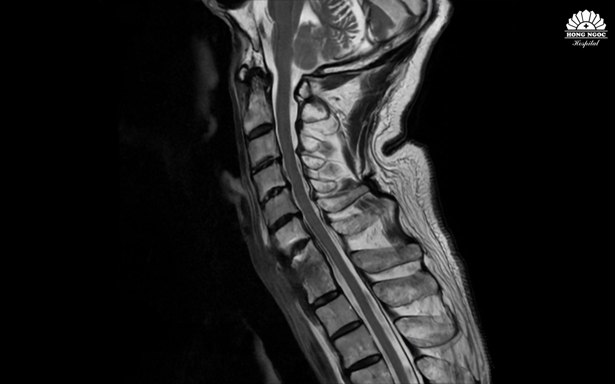섬유 띠와 염증 부위를 제거하여 정상적인 생리적 곡선을 회복하고 경추를 안정화시켰습니다.