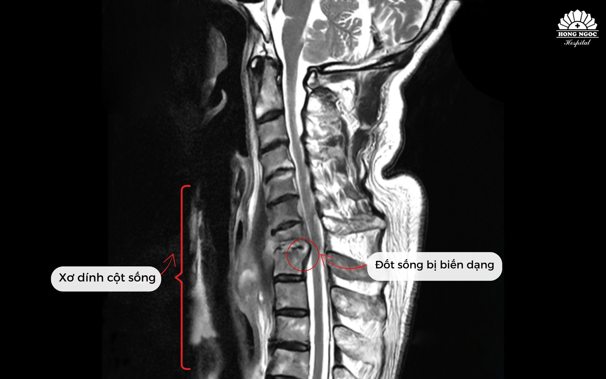 수술 전 섬유화 및 변형된 척추뼈 상태