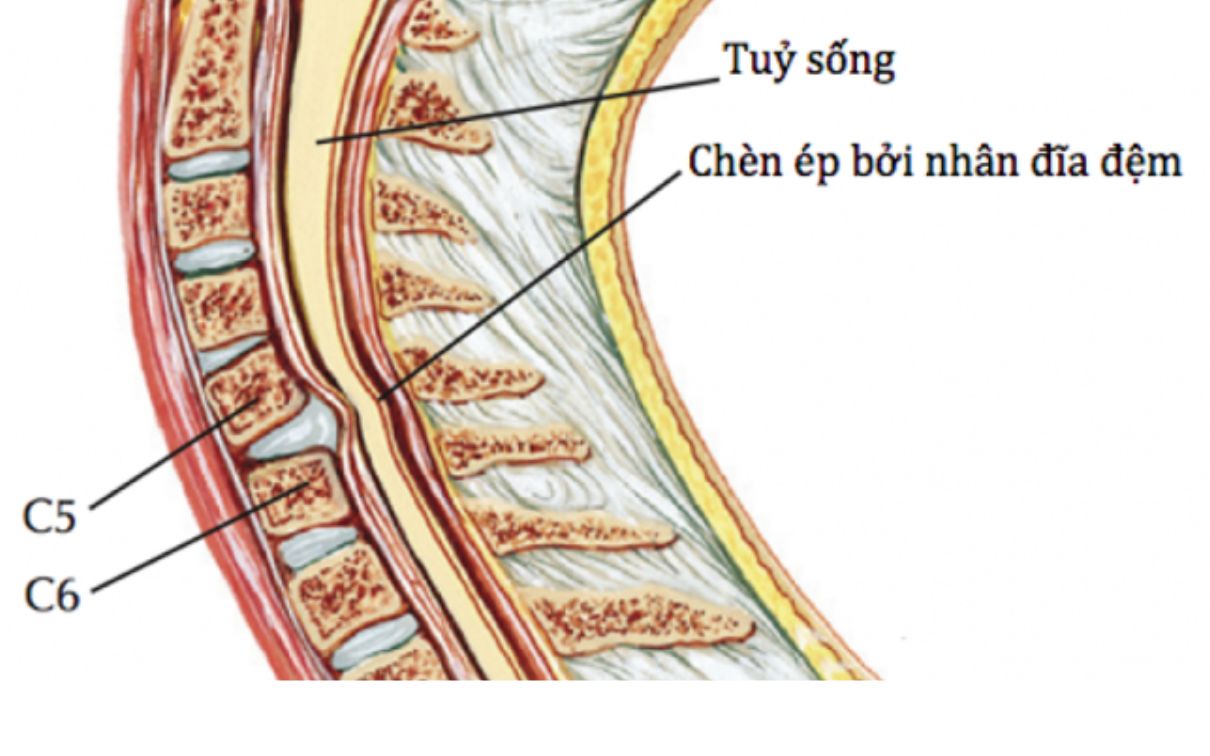 강한 충격(외력)을 받을 때 요추 척수가 손상됩니다.