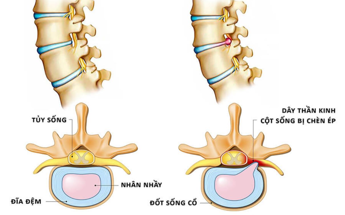 추간판 탈출증(디스크)은 척수 손상의 원인 중 하나입니다.