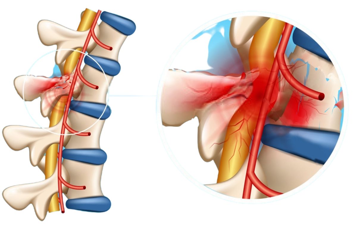 강한 충격(외력)을 받을 때 요추 척수가 손상됩니다.