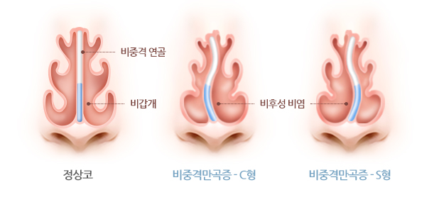 비중격만곡증은 다발성 부비동염의 원인이 됩니다