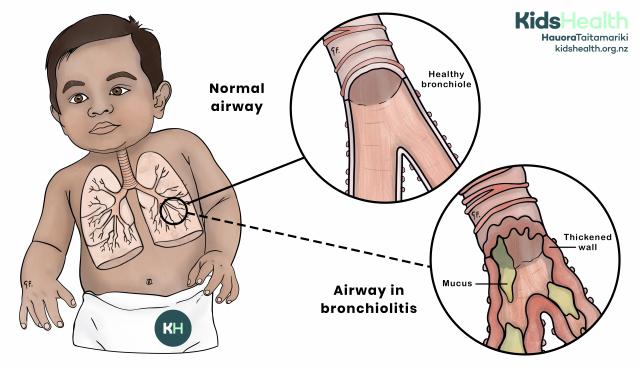 Image of a child’s bronchial tube containing excessive mucus
