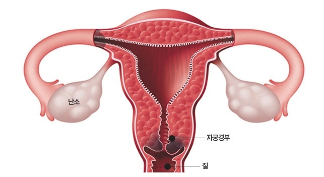 자궁경부 미란이란