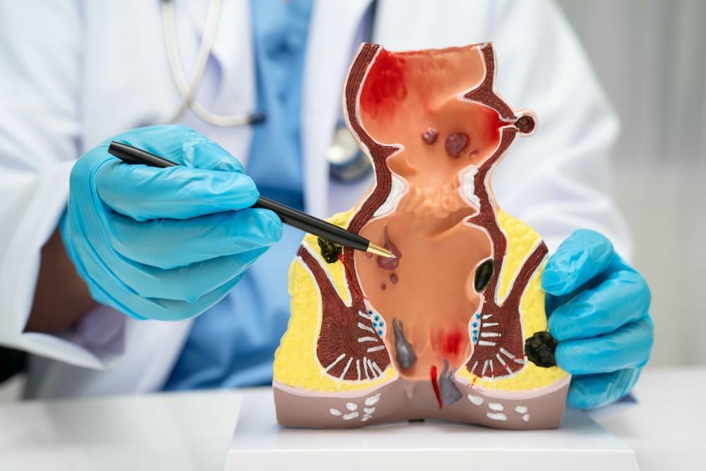 치질은 항문 및 직장 하부 정맥이 확장된 상태를 말합니다.