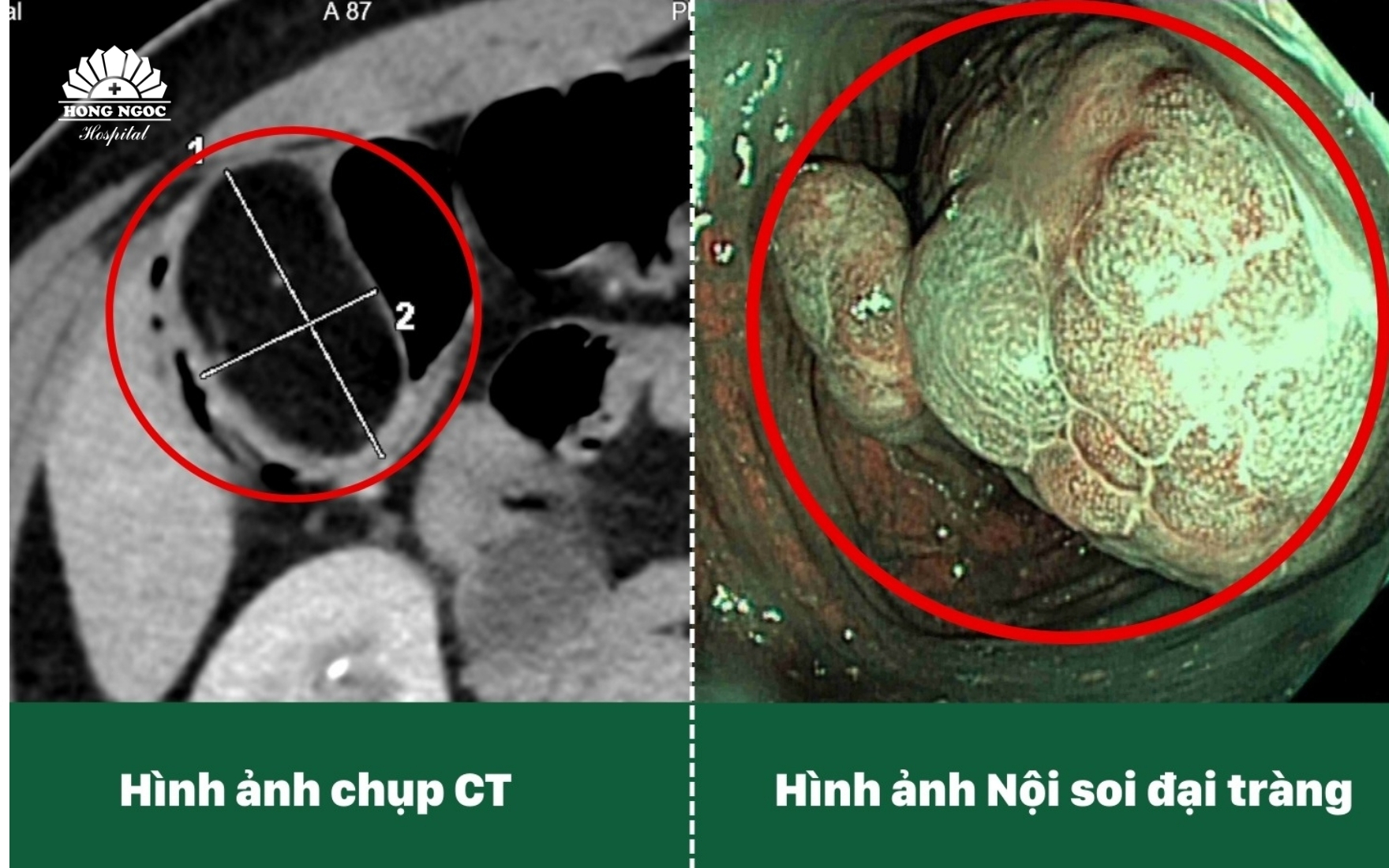 5cm 크기의 대장 종양