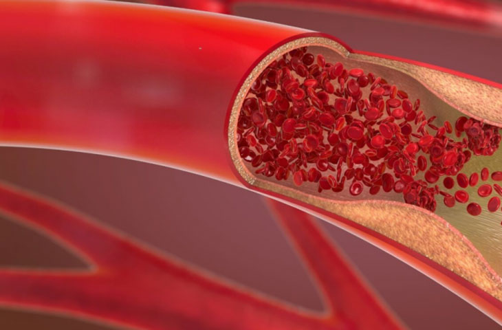 심근허혈은 환자에게 어지럼증 증상을 유발할 수 있습니다.