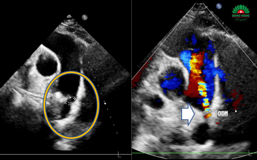 동맥관 개존증이 확인된 초음파 영상