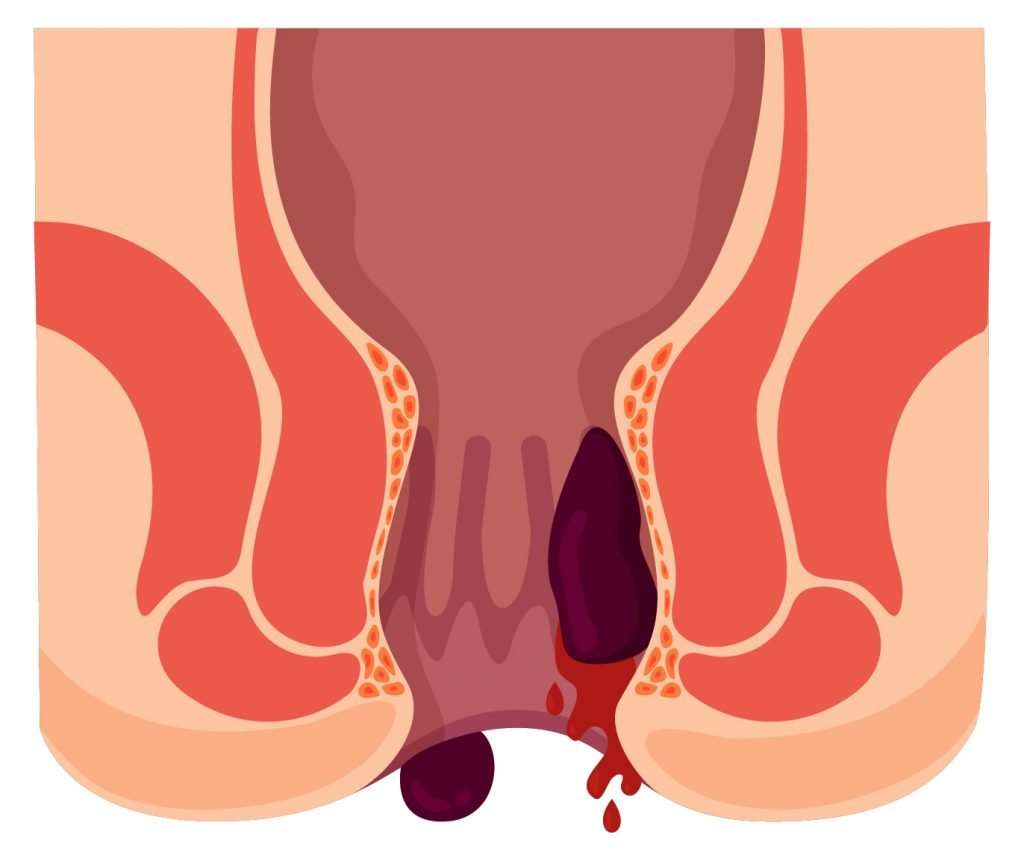 항문 밖으로 탈출한 치핵 (치질 덩어리)