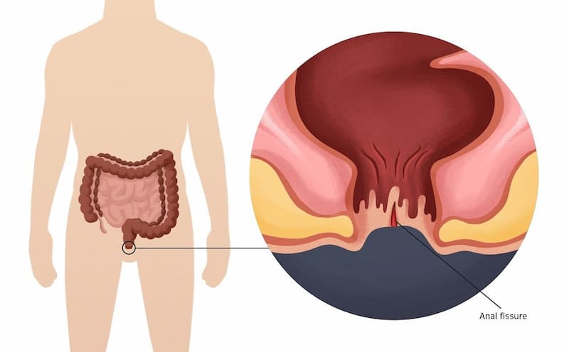 항문 통증은 치열(항문 균열)의 증상일 수도 있습니다.
