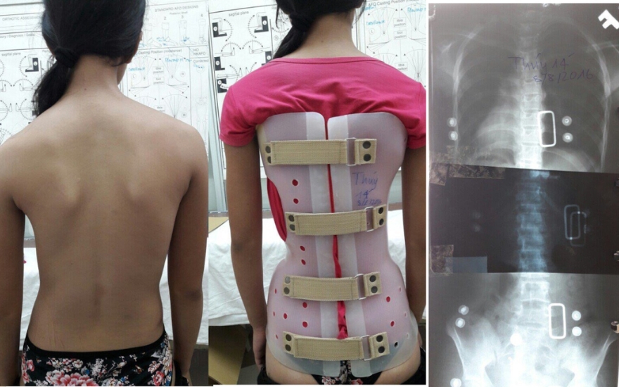 보조기(정형외과용 보조기)는 성장 과정에 있는 아동의 자세를 교정하는 능력이 있습니다.